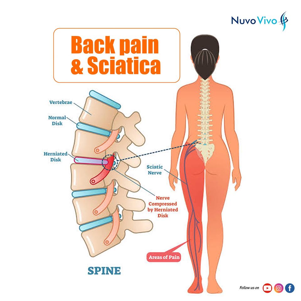 Back pain and Sciatica