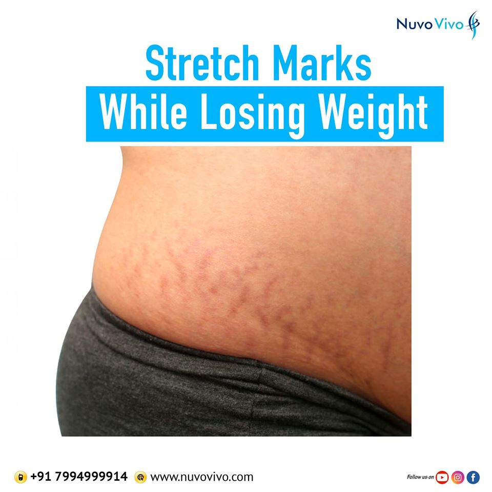 Stretch marks while losing weight