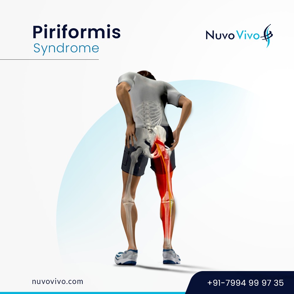 Piriformis syndrome What is