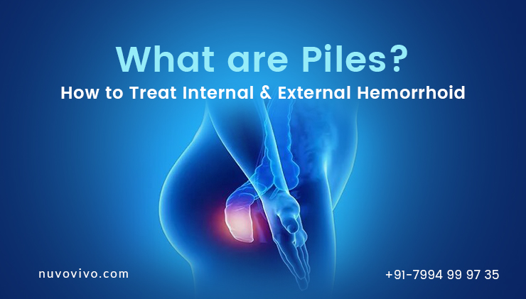 What are Piles - How to treat internal and external hemorroid