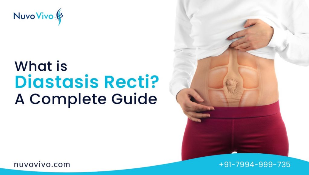 What is Diastasis Recti - Causes, Symptoms, Treatment