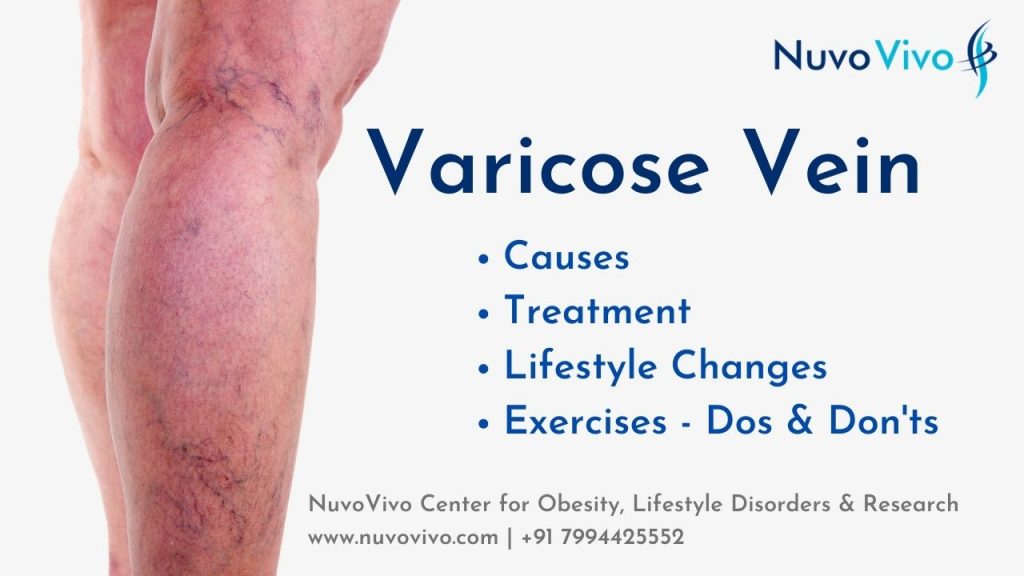 Varicose Vein best doctor treatment exercise and diet kochi